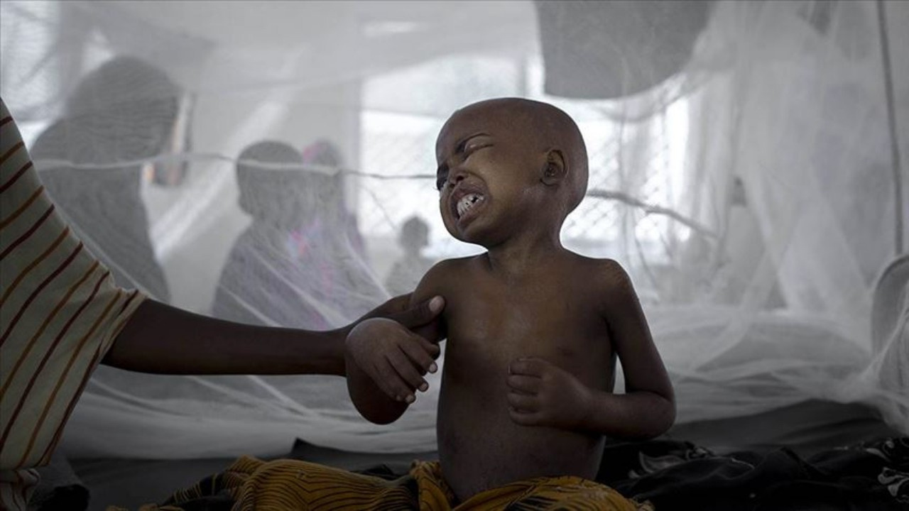 2.5M Nigerian children suffering from malnutrition