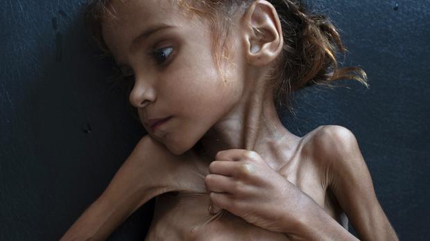 Yemen’s symbol of humanitarian crisis Amal Hussain dies aged seven