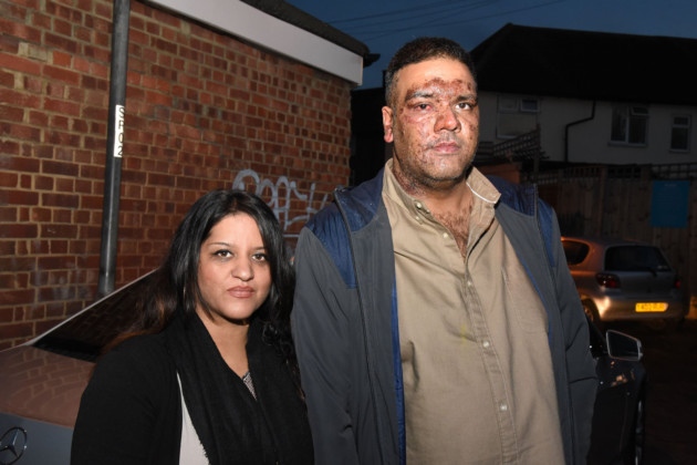British Pakistani businessman left with horrific burns after acid attack in London by a white racist gang