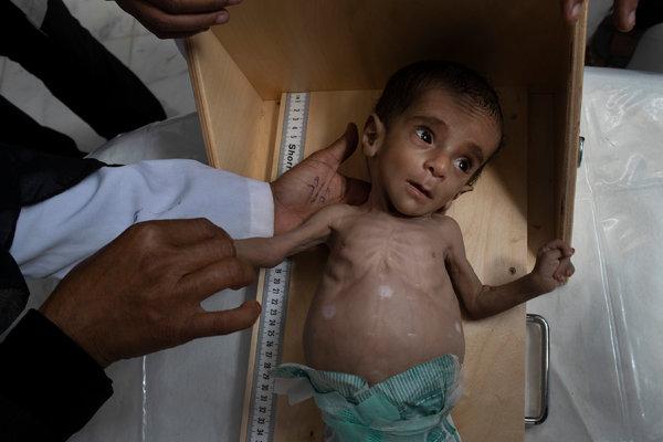 UNICEF: Yemen’de 400 bin çocuk yetersiz beslenmeden her an ölebilir